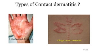 Types of Contact dermatitis ?
142a
Allergic contact dermatitis
Irritant contact dermatitis
 