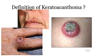 Definition of Keratoacanthoma ?
143a
 