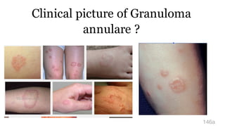 Clinical picture of Granuloma
annulare ?
146a
 