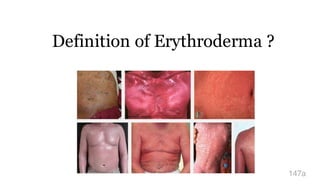 Definition of Erythroderma ?
147a
 