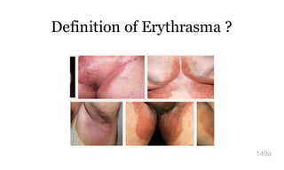 Definition of Erythrasma ?
149a
 