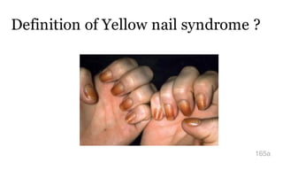 Definition of Yellow nail syndrome ?
165a
 