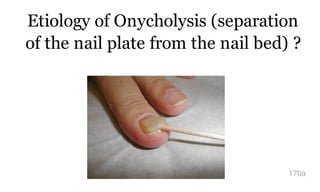 Etiology of Onycholysis (separation
of the nail plate from the nail bed) ?
170a
 