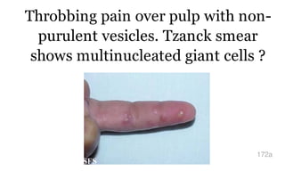 Throbbing pain over pulp with non-
purulent vesicles. Tzanck smear
shows multinucleated giant cells ?
172a
 