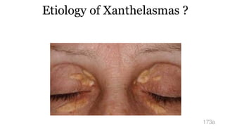 Etiology of Xanthelasmas ?
173a
 