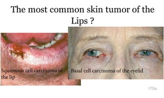 The most common skin tumor of the
Lips ?
175a
Basal cell carcinoma of the eyelidSquamous cell carcinoma of
the lip
 