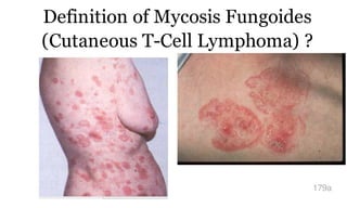 Definition of Mycosis Fungoides
(Cutaneous T-Cell Lymphoma) ?
179a
 