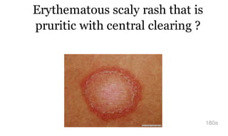 Erythematous scaly rash that is
pruritic with central clearing ?
180a
 