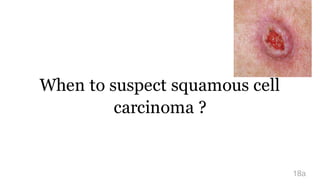 When to suspect squamous cell
carcinoma ?
18a
 