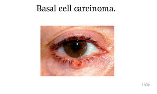 Basal cell carcinoma.
183b
 