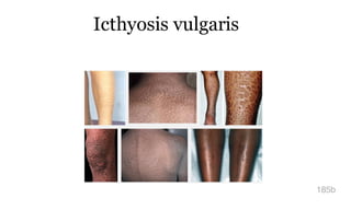 Icthyosis vulgaris
185b
 