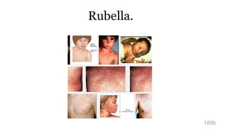 Rubella.
189b
 