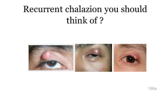 Recurrent chalazion you should
think of ?
190a
 