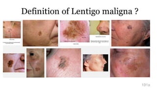 Definition of Lentigo maligna ?
191a
 