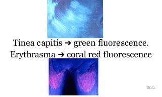 Tinea capitis ➜ green fluorescence.
Erythrasma ➜ coral red fluorescence
192b
 