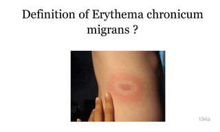 Definition of Erythema chronicum
migrans ?
194a
 