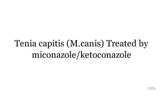 Tenia capitis (M.canis) Treated by
miconazole/ketoconazole
195b
 