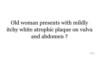 Old woman presents with mildly
itchy white atrophic plaque on vulva
and abdomen ?
196a
 