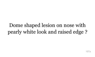 Dome shaped lesion on nose with
pearly white look and raised edge ?
197a
 