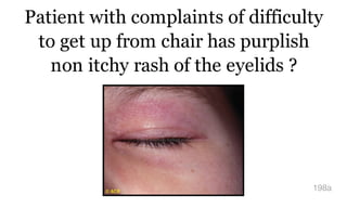Patient with complaints of difficulty
to get up from chair has purplish
non itchy rash of the eyelids ?
198a
 