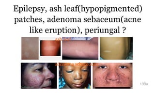 Epilepsy, ash leaf(hypopigmented)
patches, adenoma sebaceum(acne
like eruption), periungal ?
199a
ash leaf
adenoma sebaceoum
 