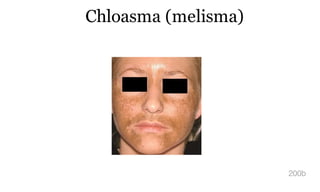 Chloasma (melisma)
200b
 