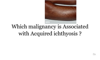 Which malignancy is Associated
with Acquired ichthyosis ?
2a
 