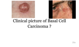 Clinical picture of Basal Cell
Carcinoma ?
20a
 