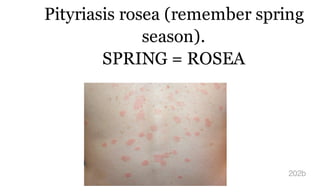 Pityriasis rosea (remember spring
season).
SPRING = ROSEA
202b
 