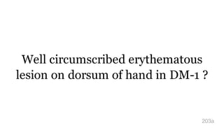 Well circumscribed erythematous
lesion on dorsum of hand in DM-1 ?
203a
 