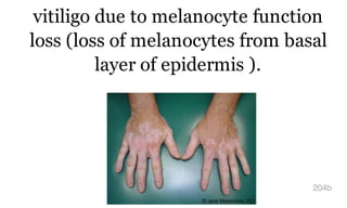 vitiligo due to melanocyte function
loss (loss of melanocytes from basal
layer of epidermis ).
204b
 