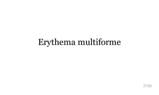 Erythema multiforme
210b
 