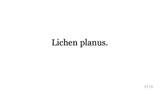 Lichen planus.
211b
 