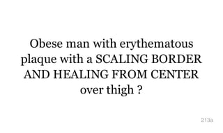 Obese man with erythematous
plaque with a SCALING BORDER
AND HEALING FROM CENTER
over thigh ?
213a
 