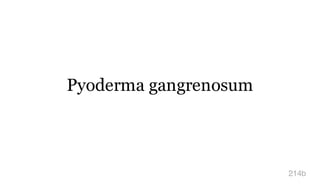 Pyoderma gangrenosum
214b
 