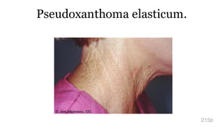 Pseudoxanthoma elasticum.
215b
 