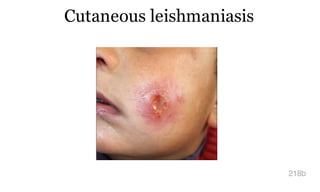 Cutaneous leishmaniasis
218b
 