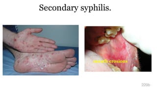 Secondary syphilis.
220b
mouth erosions
 
