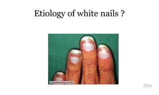 Etiology of white nails ?
222a
 