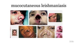 mucocutaneous leishmaniasis
223b
 