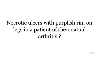 Necrotic ulcers with purplish rim on
legs in a patient of rheumatoid
arthritis ?
225a
 