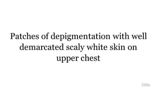 Patches of depigmentation with well
demarcated scaly white skin on
upper chest
226a
 