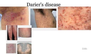 Darier's disease
228b
 