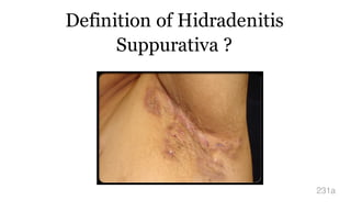 Definition of Hidradenitis
Suppurativa ?
231a
 