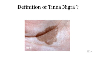 Definition of Tinea Nigra ?
233a
 