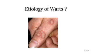 Etiology of Warts ?
236a
 