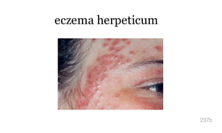 eczema herpeticum
237b
 