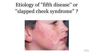 Etiology of "fifth disease" or
"slapped cheek syndrome" ?
243a
 