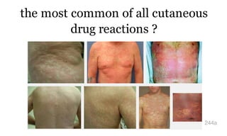 the most common of all cutaneous
drug reactions ?
244a
 