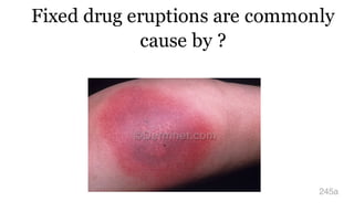 Fixed drug eruptions are commonly
cause by ?
245a
 